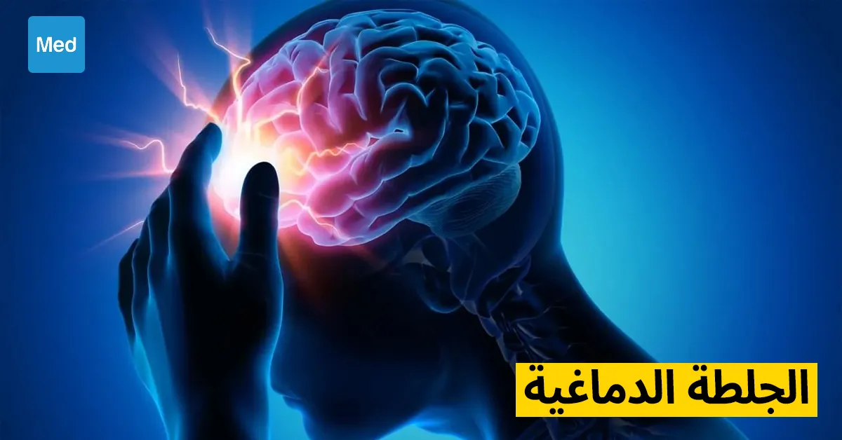الجلطة الدماغية: التشخيص والعلاج والوقاية
